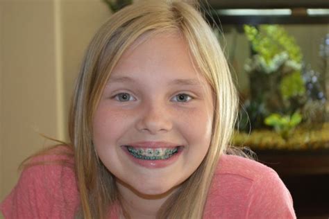 girl with braces leaked|Braces girl : r/bracesgirlr